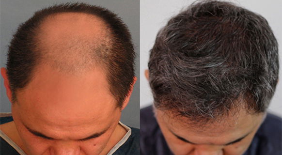 Hair Transplant Treatment - Dr Harini